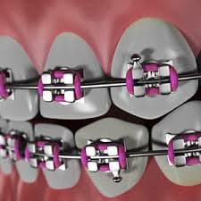 traditional metal braces